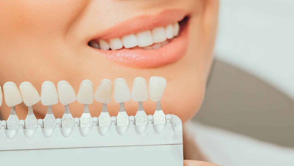 ציפוי חרסינה לשיניים