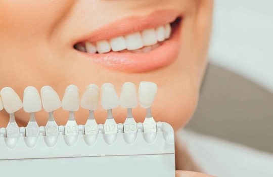 ציפוי חרסינה לשיניים2